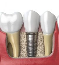 Dental Implants