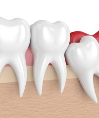 Wisdom tooth extraction