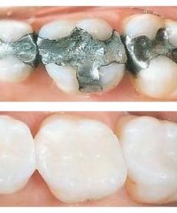 Cosmetic fillings