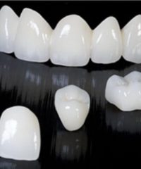 Metal free crowns and bridges