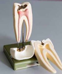 Root canal treatment